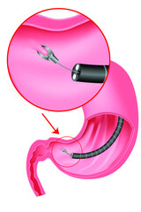 Biopsy of the stomach. Taking a sample of the mucous membrane for research. Introduction of the endoscope through the esophagus. Gastroscopy. Vector illustration - obrazy, fototapety, plakaty