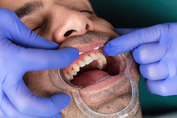 dental treatment in a clinic. mouth and dental health. healthcare and medicine concept.
