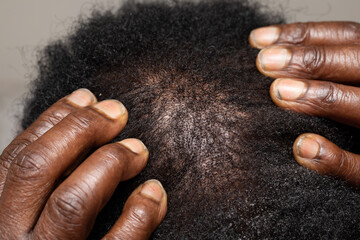 Thin hair loss on afro-american man scalp - obrazy, fototapety, plakaty