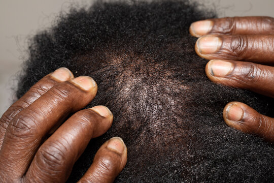 Thin hair loss on afro-american man scalp