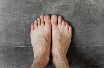 Fototapeta premium male feet with fungus and different dermatological problems close-up on a dark background. hairy feet. toenail problem. foot skin problem
