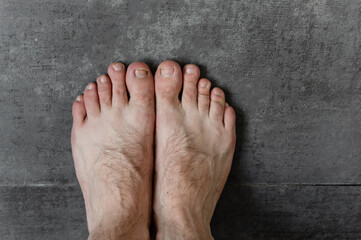 Fototapeta premium male feet with fungus and different dermatological problems close-up on a dark background. hairy feet. toenail problem. foot skin problem