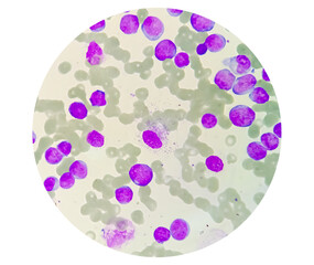 Blood Cancer, Leukemia Awareness. Photomicrograph of bone marrow aspirate showing myeloblasts of...