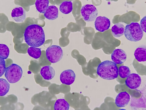 Blood Cancer, Leukemia Awareness. Photomicrograph of bone marrow aspirate showing myeloblasts of acute myeloid leukemia (AML), a cancer of white blood cells