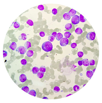 Blood Cancer, Leukemia Awareness. Photomicrograph of bone marrow aspirate showing myeloblasts of acute myeloid leukemia (AML), a cancer of white blood cells
