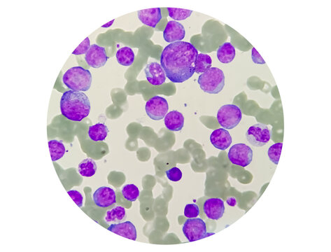 Blood Cancer, Leukemia Awareness. Photomicrograph of bone marrow aspirate showing myeloblasts of acute myeloid leukemia (AML), a cancer of white blood cells