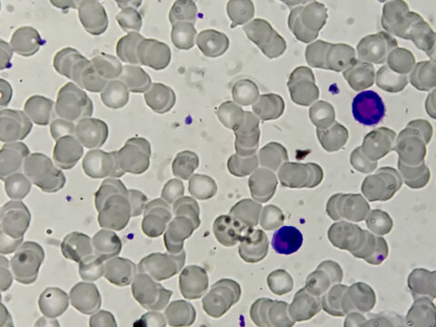 Blood Smear Microscopic Show Reactive Lymphocytes And Neutropenia.