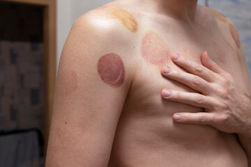 Bruise, trace on skin from vacuum can. Vacuum treatment of shoulders of man. Traces of treatment.