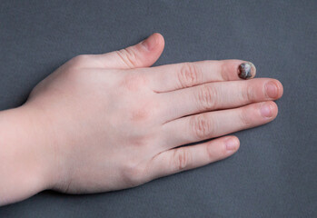Black sore nail after a strong blow. Finger injury and a hematoma formed under the nail
