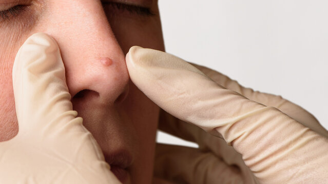 Diagnosis of mole or nevus on woman's face. Doctor's hands in surgical gloves examining nevi on nose. Skin mole check concept. Closeup. Copy space.