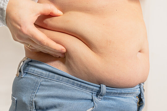 overweight woman holding fold of excess fat on stomach