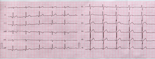 Electrocardiogram close-up on paper, cardiology and health care
