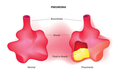 pneumonia in alveoli,  alveolar fluid (fluid in alveoli)