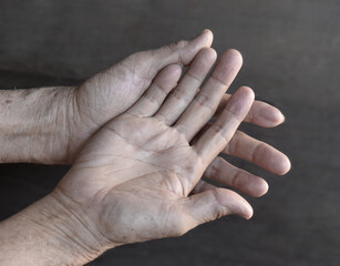 Pale palmar surface of both hands. Anaemic hands of Asian, Chinese man.