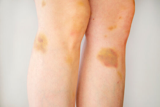 Hematomas on the body