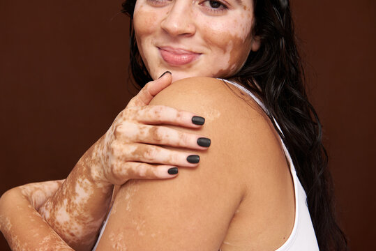 Happy asian woman with Vitiligo skin 