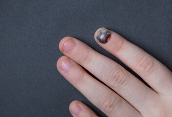 Black sore nail after a strong blow close up. Finger injury and a hematoma formed under the nail
