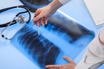 Doctor examines x-ray image of lungs lying on the light table. - 486695143
