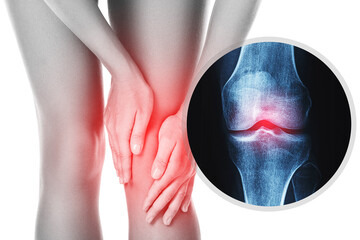 Knee and and X-ray effect with an injured joint - obrazy, fototapety, plakaty