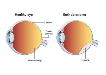 Medical illustration compares a healthy eye with one affected by retinoblastoma.