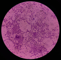 Microscopic view of Enterococcus bacteria from UTI patient urine sample, show gram-positive cocci...