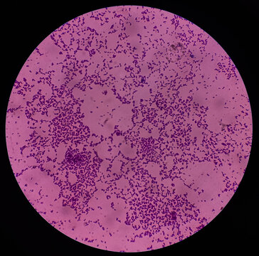 Microscopic view of Enterococcus bacteria from UTI patient urine sample, show gram-positive cocci at gram's staining slide. focus view