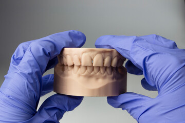 hands in blue gloves hold a dental model of the upper and lower jaws