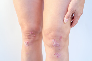 Knee joint effusion ( water on the knee).Acute psoriatic arthritis, arthrosis ,meniscus...