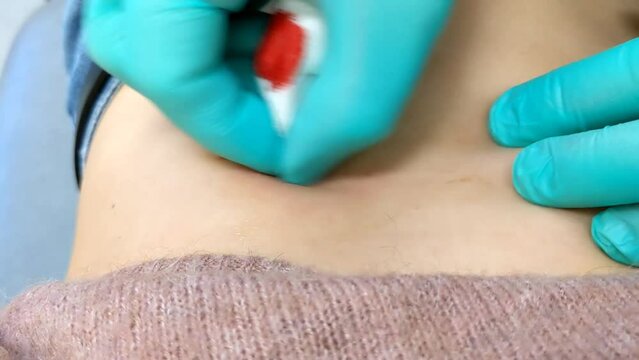 Cleaning the wound with a scalpel before stitching the lesion after benign skin lesion, mole removal. Fibroepithelial Polyp on Abdomen