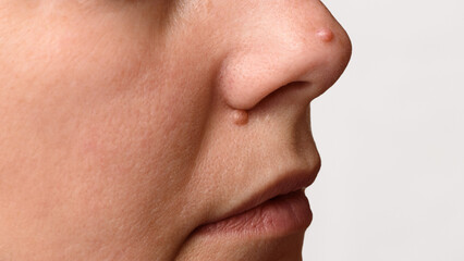 Closeup of two big moles or nevus on face. Nevi on nose of woman. Mole check and skin cancer prevention concept. - obrazy, fototapety, plakaty