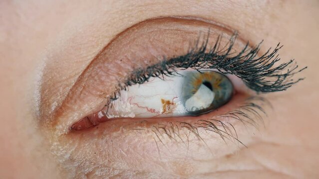 Eye freckle. Person with a birthmark on the eyeball looks left and right