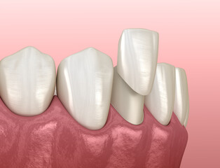 Veneer placement procedure. Medically accurate tooth 3D illustration