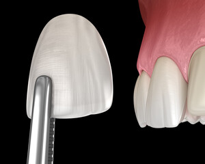 Veneer installation procedure over central incisor. Medically accurate tooth 3D illustration © Alex Mit