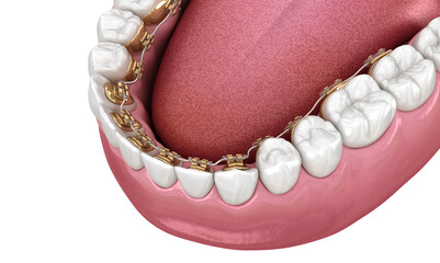 Healthy Teeth with gold braces, dental 3D illustration