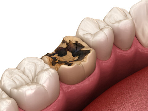 Tooth damaged by caries. Medically accurate tooth 3D illustration.