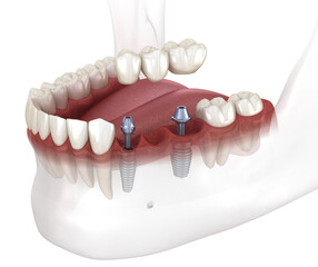 Dental bridge supported by implants. Medically accurate 3D illustration of human teeth and dentures concept - obrazy, fototapety, plakaty