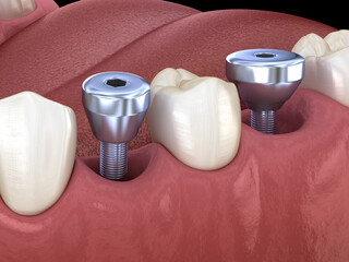 Cover screw - temporary implant abutment. Medically accurate 3D illustration of human teeth and dentures concept - obrazy, fototapety, plakaty