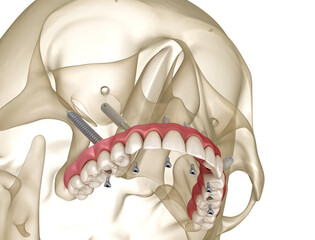 Maxillary prosthesis supported by zygomatic implants. Medically accurate 3D illustration of human teeth and dentures - 487012733