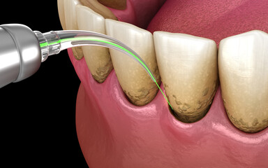 Laser removes tartar and thin layer of infected skin, teeth cleaning. Medically accurate tooth 3D illustration