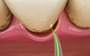 Laser removes tartar and thin layer of infected skin, teeth cleaning. Medically accurate tooth 3D illustration