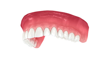 Maxillary prosthesis supported by 2 teeth and 4 implants. Medically accurate 3D illustration