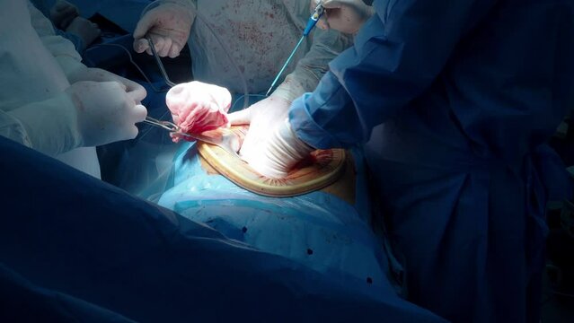 The hands of surgeons in sterile gloves operate with an electric coagulator. An incision of the patient's internal organs with an electric coagulator during surgery.