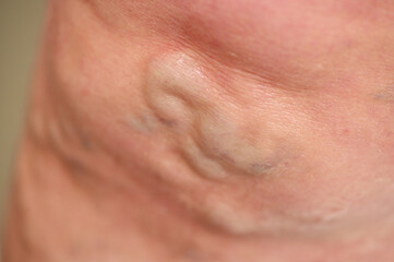varicose veins close-up on the patient's leg.