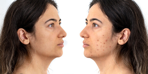 Before after photo up photo of woman with excessive amont of pimples on the face. Concept of beauty and skin care.
