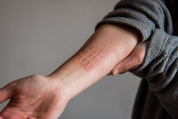 Detalle del brazo de una mujer que padece una afección de la piel llamada dermografismo, dermatografismo o "escritura en la piel", un tipo de urticaria común y benigna.