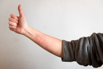 Detalle de un brazo con síntomas de una condición de la piel llamada dermografismo o dermatografismo. Mujer haciendo el signo de ok con la mano, pulgar hacia arriba