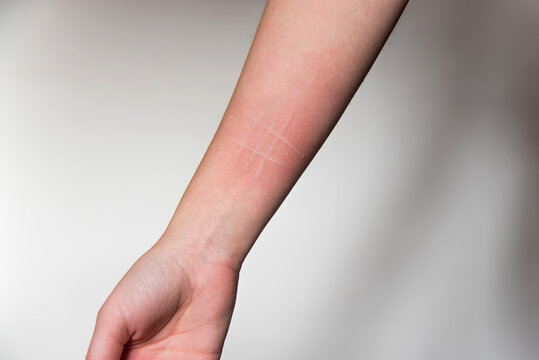 Detalle del brazo de una mujer que padece una afecci&oacute;n de la piel llamada dermografismo, dermatografismo o "escritura en la piel", un tipo de urticaria com&uacute;n y benigna.