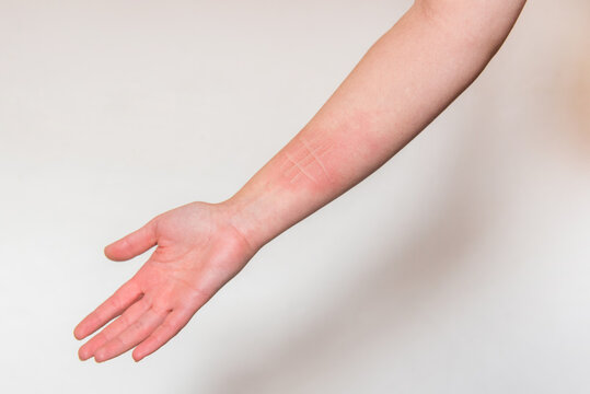 Detalle del brazo de una mujer que padece una afecci&oacute;n de la piel llamada dermografismo, dermatografismo o "escritura en la piel", un tipo de urticaria com&uacute;n y benigna.