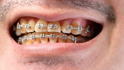 Close up of Man's mouth with braces , yellow plaque teeth  because drinking coffee regularly