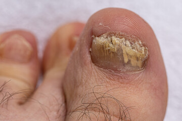 Feet of a man close-up of fingers affected by a fungal nail plate. Ugly toes. - obrazy, fototapety, plakaty